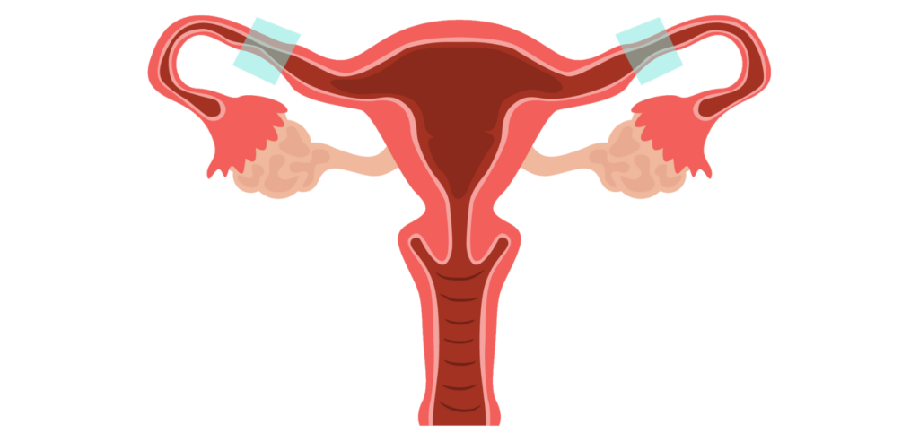 IVF After Tubectomy: Pregnancy Chances and Guidance After Ectopic Pregnancy